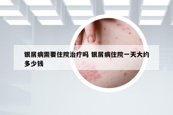 银屑病需要住院治疗吗 银屑病住院一天大约多少钱