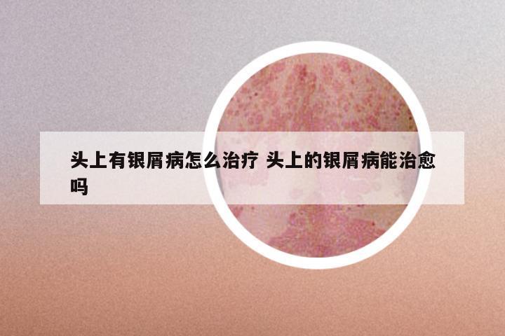 头上有银屑病怎么治疗 头上的银屑病能治愈吗