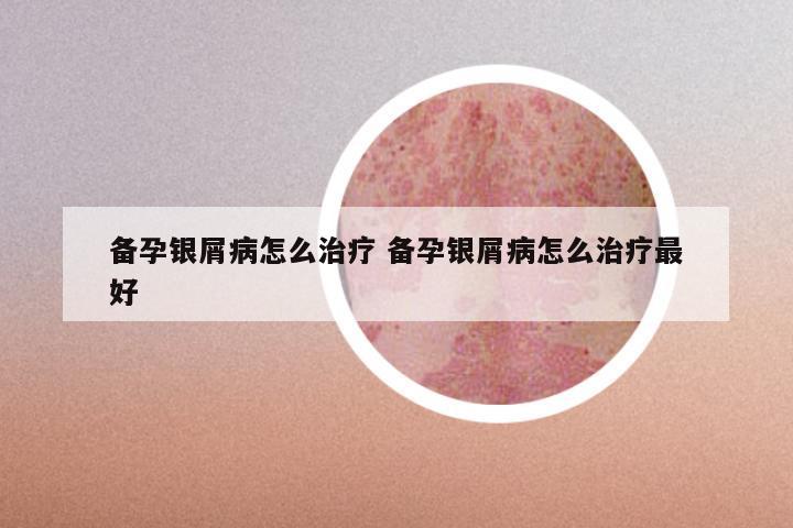 备孕银屑病怎么治疗 备孕银屑病怎么治疗最好