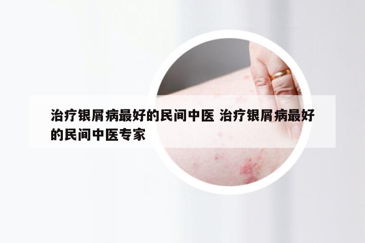 治疗银屑病最好的民间中医 治疗银屑病最好的民间中医专家