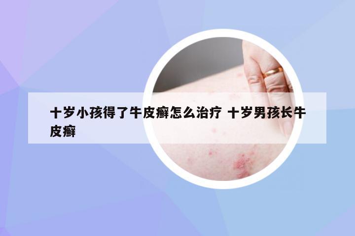 十岁小孩得了牛皮癣怎么治疗 十岁男孩长牛皮癣