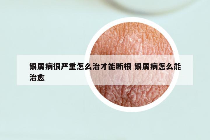 银屑病很严重怎么治才能断根 银屑病怎么能治愈