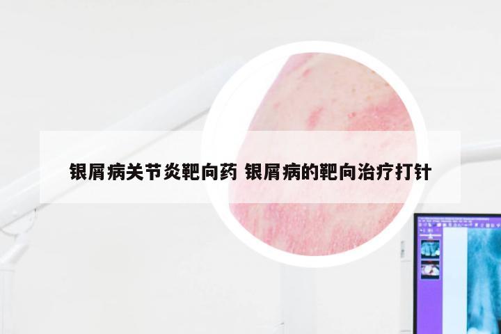 银屑病关节炎靶向药 银屑病的靶向治疗打针