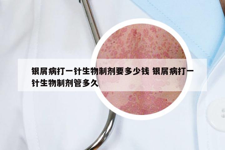 银屑病打一针生物制剂要多少钱 银屑病打一针生物制剂管多久
