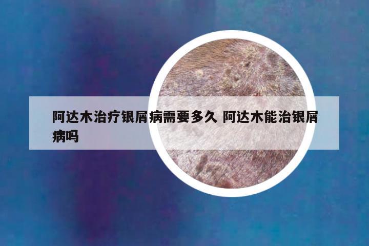 阿达木治疗银屑病需要多久 阿达木能治银屑病吗