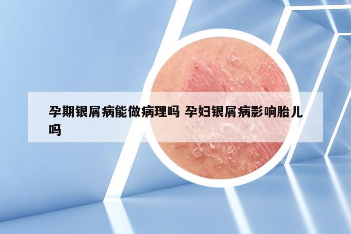 孕期银屑病能做病理吗 孕妇银屑病影响胎儿吗