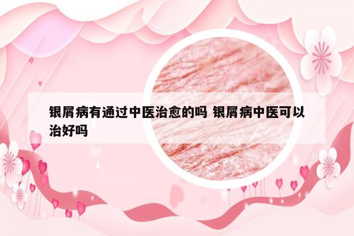 银屑病有通过中医治愈的吗 银屑病中医可以治好吗