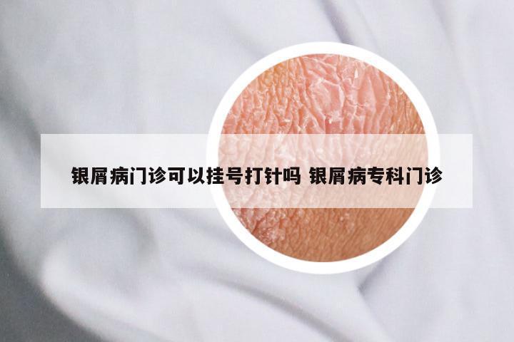银屑病门诊可以挂号打针吗 银屑病专科门诊