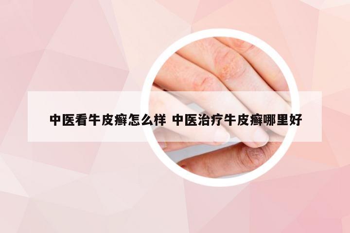 中医看牛皮癣怎么样 中医治疗牛皮癣哪里好