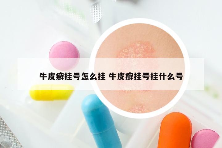 牛皮癣挂号怎么挂 牛皮癣挂号挂什么号