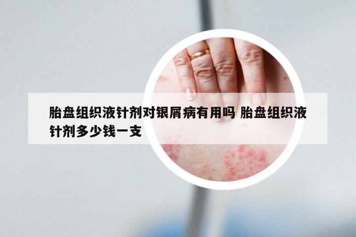 胎盘组织液针剂对银屑病有用吗 胎盘组织液针剂多少钱一支