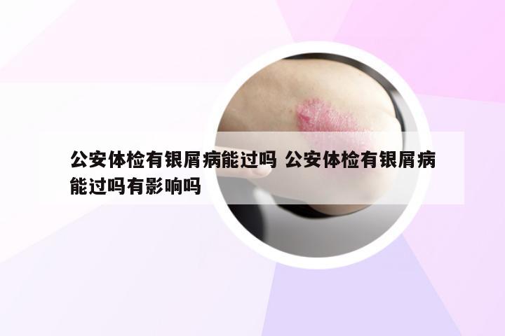 公安体检有银屑病能过吗 公安体检有银屑病能过吗有影响吗