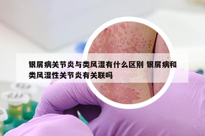 银屑病关节炎与类风湿有什么区别 银屑病和类风湿性关节炎有关联吗