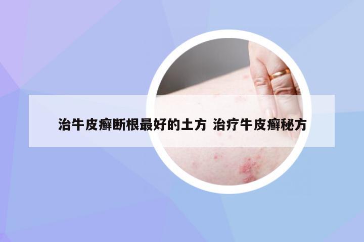治牛皮癣断根最好的土方 治疗牛皮癣秘方