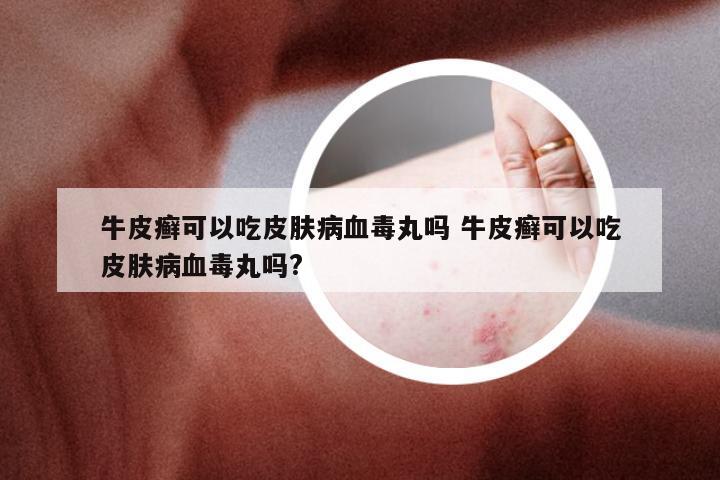 牛皮癣可以吃皮肤病血毒丸吗 牛皮癣可以吃皮肤病血毒丸吗?