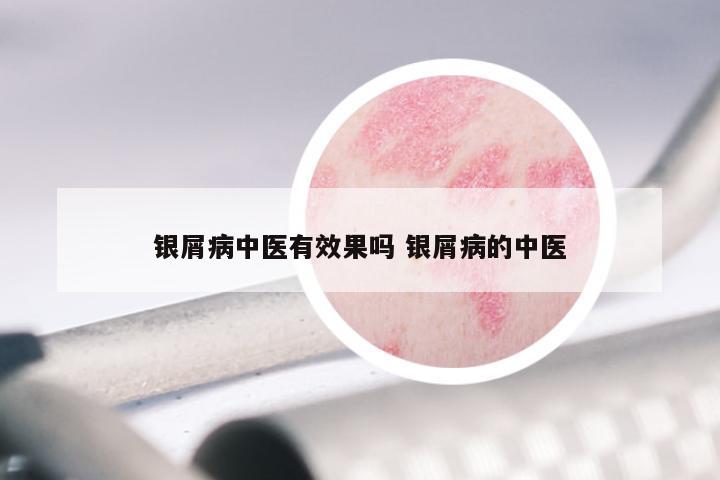 银屑病中医有效果吗 银屑病的中医