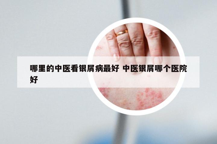 哪里的中医看银屑病最好 中医银屑哪个医院好