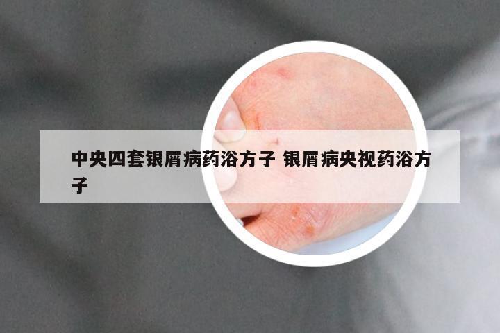 中央四套银屑病药浴方子 银屑病央视药浴方子