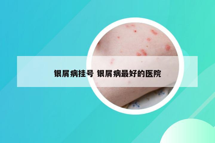 银屑病挂号 银屑病最好的医院