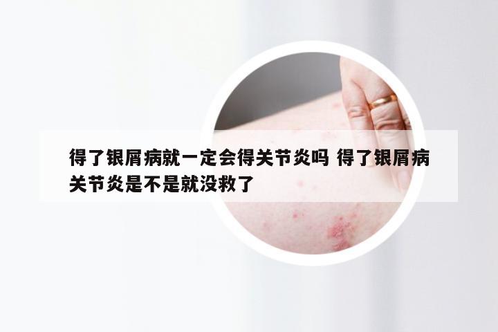 得了银屑病就一定会得关节炎吗 得了银屑病关节炎是不是就没救了