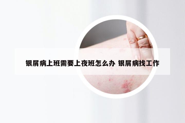银屑病上班需要上夜班怎么办 银屑病找工作