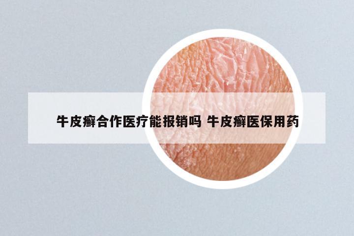 牛皮癣合作医疗能报销吗 牛皮癣医保用药
