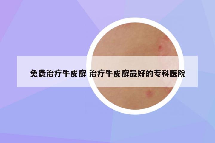免费治疗牛皮癣 治疗牛皮癣最好的专科医院