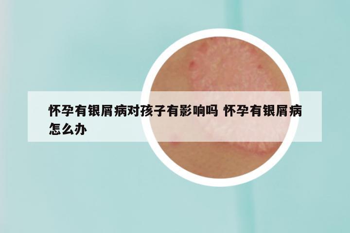 怀孕有银屑病对孩子有影响吗 怀孕有银屑病怎么办