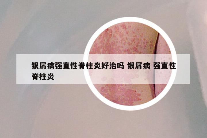 银屑病强直性脊柱炎好治吗 银屑病 强直性脊柱炎