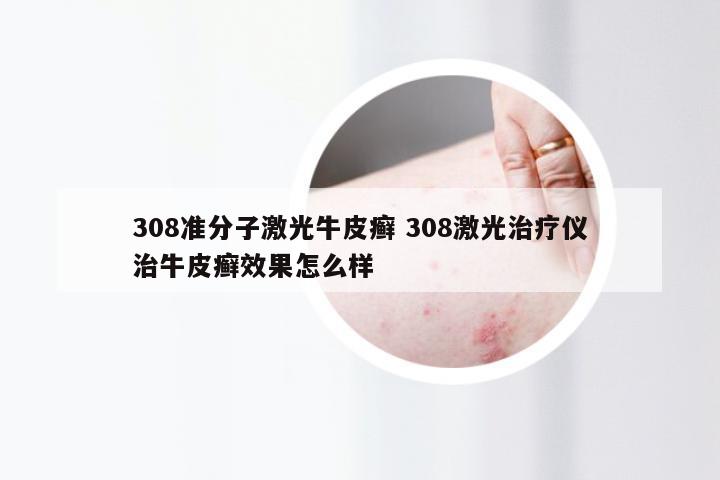 308准分子激光牛皮癣 308激光治疗仪治牛皮癣效果怎么样