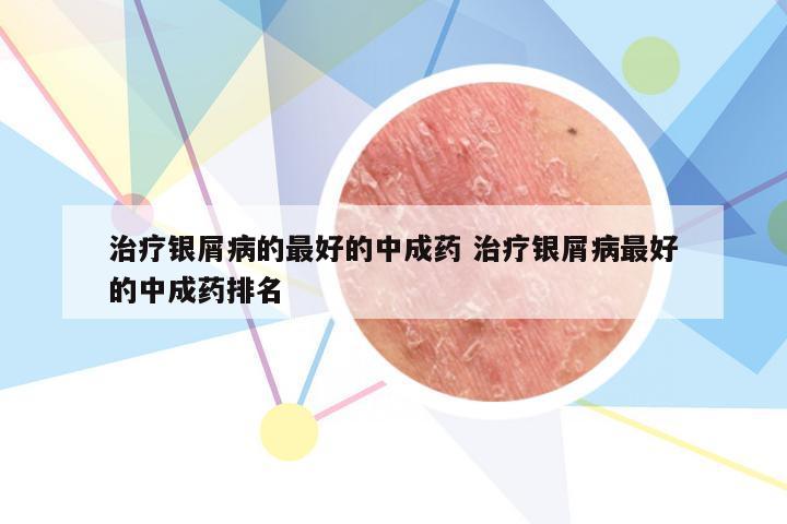 治疗银屑病的最好的中成药 治疗银屑病最好的中成药排名