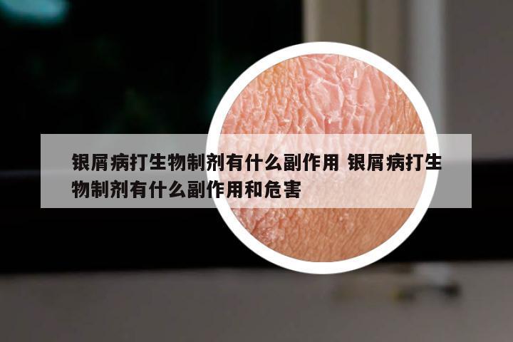 银屑病打生物制剂有什么副作用 银屑病打生物制剂有什么副作用和危害