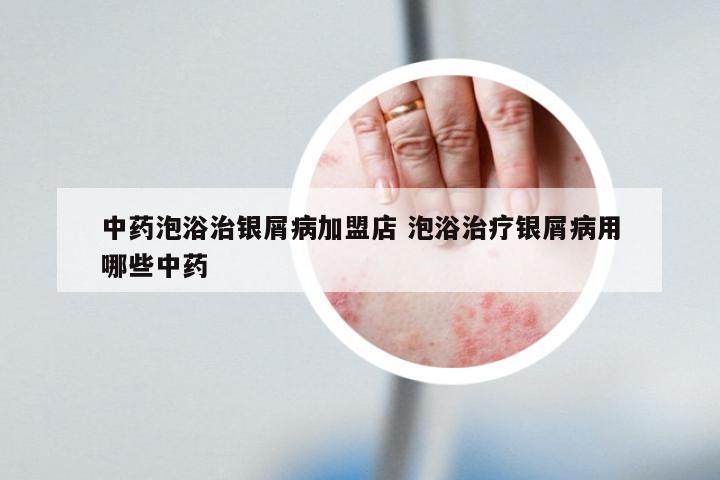 中药泡浴治银屑病加盟店 泡浴治疗银屑病用哪些中药