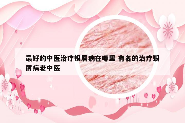 最好的中医治疗银屑病在哪里 有名的治疗银屑病老中医