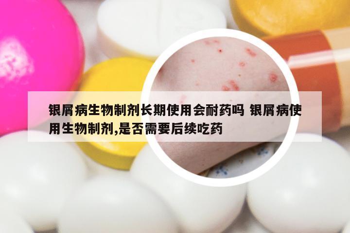 银屑病生物制剂长期使用会耐药吗 银屑病使用生物制剂,是否需要后续吃药