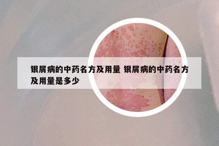 银屑病的中药名方及用量 银屑病的中药名方及用量是多少