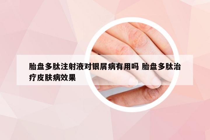 胎盘多肽注射液对银屑病有用吗 胎盘多肽治疗皮肤病效果