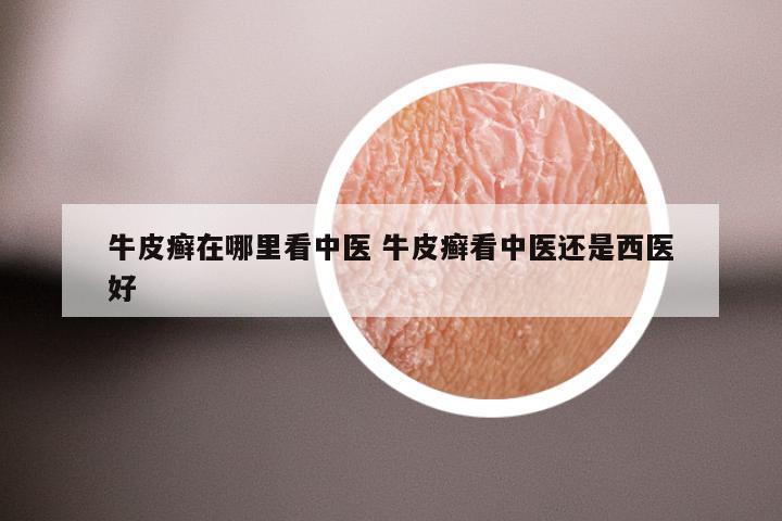 牛皮癣在哪里看中医 牛皮癣看中医还是西医好