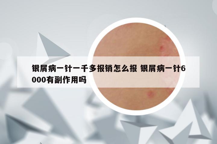 银屑病一针一千多报销怎么报 银屑病一针6000有副作用吗