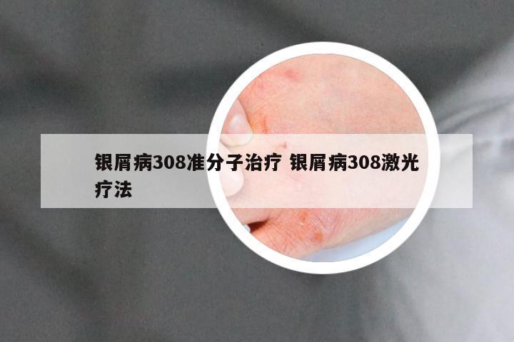 银屑病308准分子治疗 银屑病308激光疗法