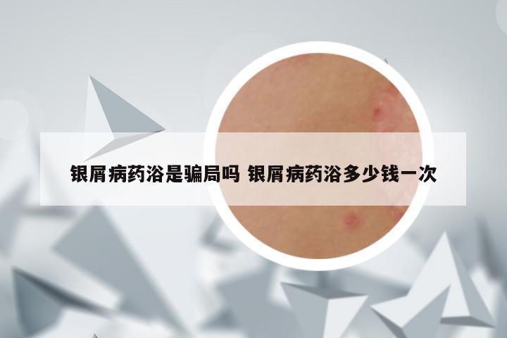 银屑病药浴是骗局吗 银屑病药浴多少钱一次