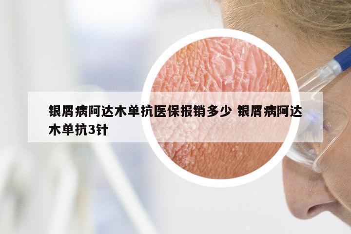银屑病阿达木单抗医保报销多少 银屑病阿达木单抗3针
