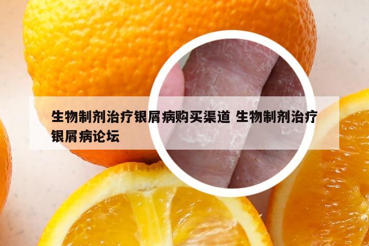 生物制剂治疗银屑病购买渠道 生物制剂治疗银屑病论坛