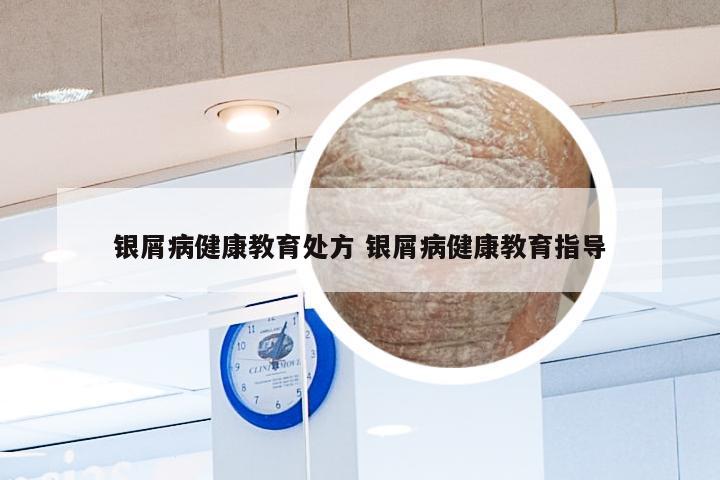 银屑病健康教育处方 银屑病健康教育指导