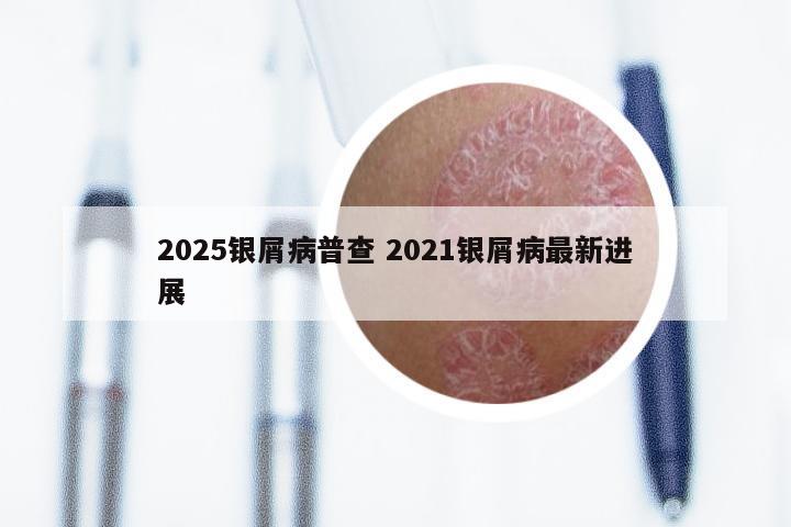 2025银屑病普查 2021银屑病最新进展