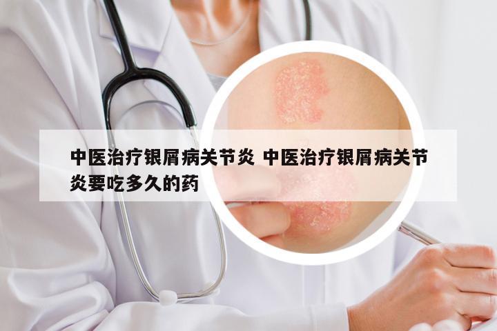 中医治疗银屑病关节炎 中医治疗银屑病关节炎要吃多久的药