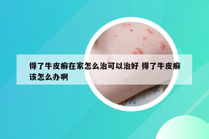 得了牛皮癣在家怎么治可以治好 得了牛皮癣该怎么办啊