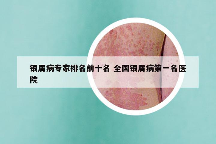 银屑病专家排名前十名 全国银屑病第一名医院