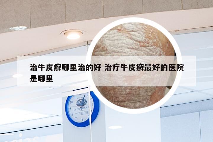 治牛皮癣哪里治的好 治疗牛皮癣最好的医院是哪里