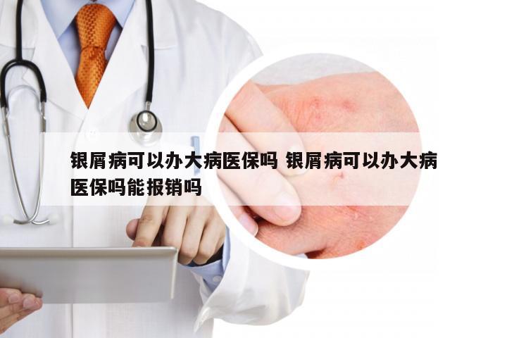 银屑病可以办大病医保吗 银屑病可以办大病医保吗能报销吗